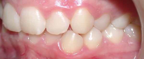 Ortodoncia Adolescentes - Ejemplo 20 - Antes