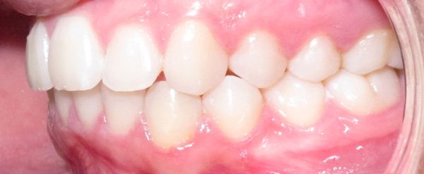 Ortodoncia Adolescentes - Ejemplo 20 - Después