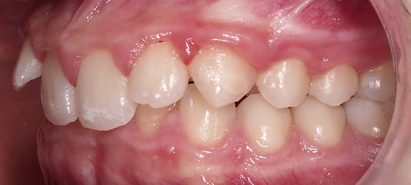 Ortodoncia Adolescentes - Ejemplo 1 - Antes