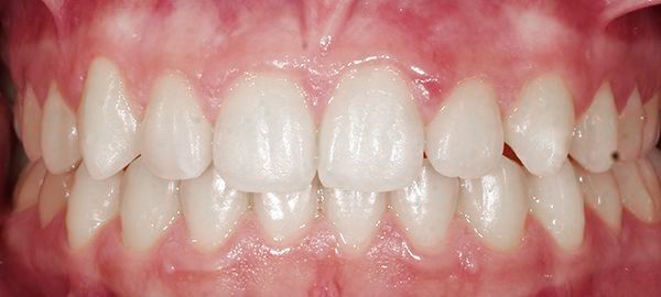 Ortodoncia Adolescentes - Ejemplo 1 - Después