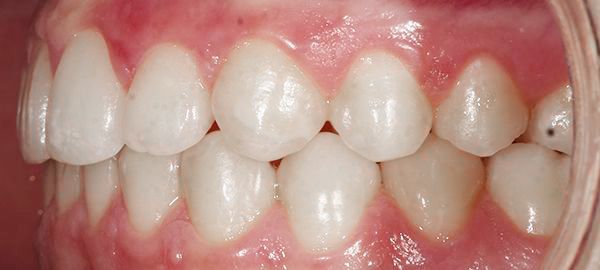 Ortodoncia Adolescentes - Ejemplo 1 - Después