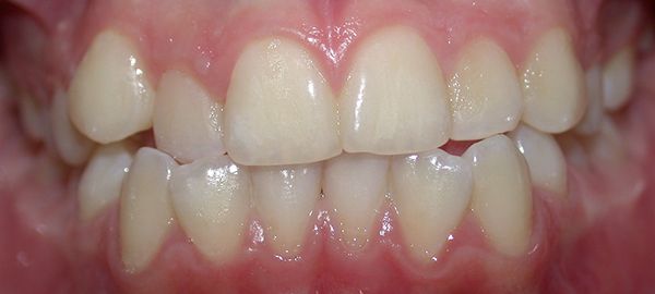 Ortodoncia Adolescentes - Ejemplo 2 - Antes