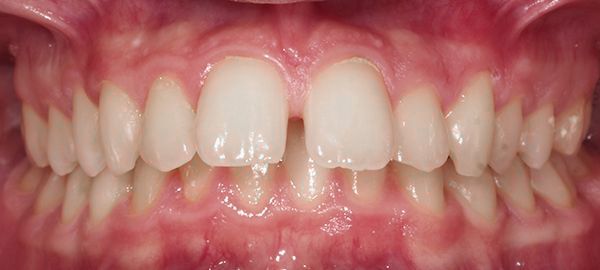 Ortodoncia Adolescentes - Ejemplo 3 - Antes