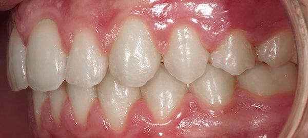 Ortodoncia Adolescentes - Ejemplo 3 - Después