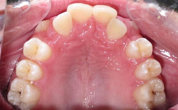 Ortodoncia Adolescentes - Ejemplo 4 - Antes