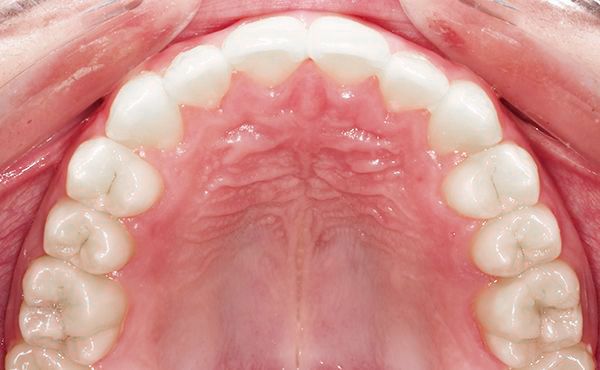 Ortodoncia Adolescentes - Ejemplo 4 - Después
