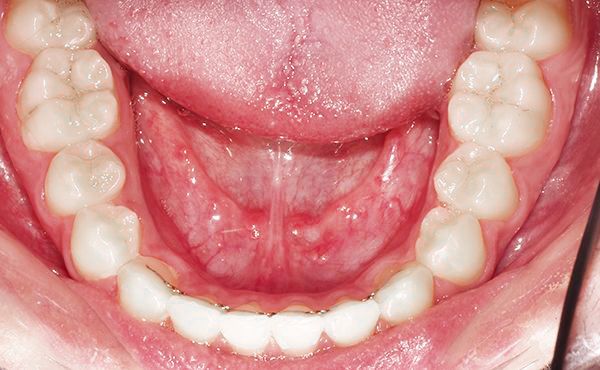 Ortodoncia Adolescentes - Ejemplo 4 - Después