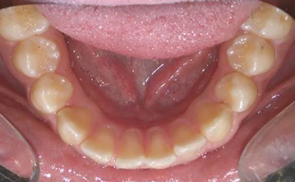 Ortodoncia Adolescentes - Ejemplo 5 - Antes