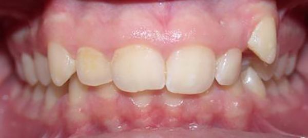 Ortodoncia Adolescentes - Ejemplo 5 - Antes