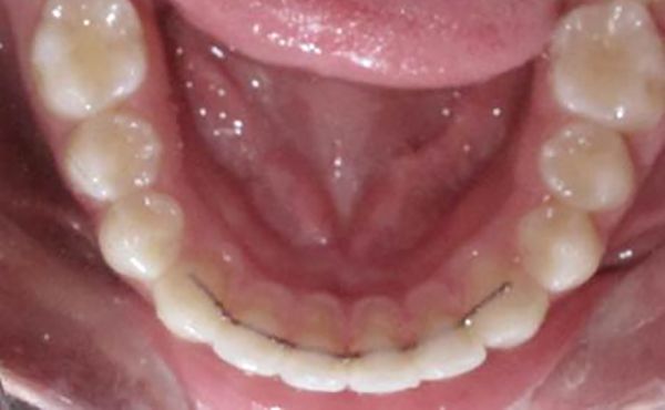 Ortodoncia Adolescentes - Ejemplo 5 - Después