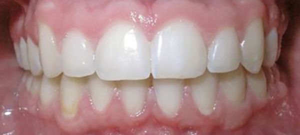Ortodoncia Adolescentes - Ejemplo 5 - Después
