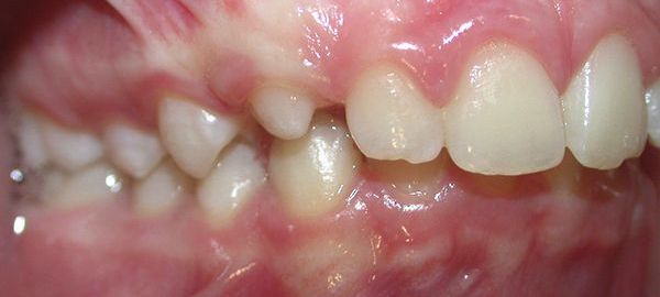 Ortodoncia Adolescentes - Ejemplo 6 - Antes