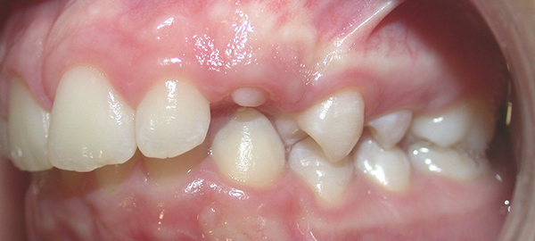 Ortodoncia Adolescentes - Ejemplo 6 - Antes