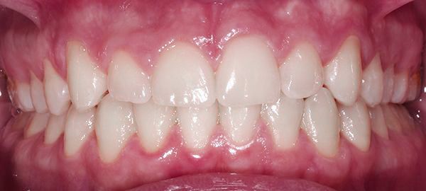 Ortodoncia Adolescentes - Ejemplo 6 - Después