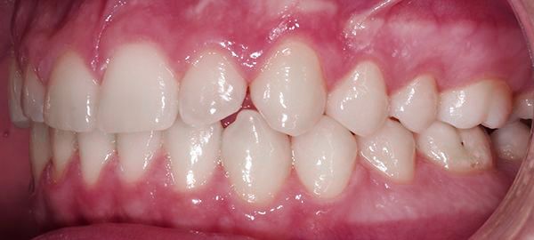 Ortodoncia Adolescentes - Ejemplo 6 - Después