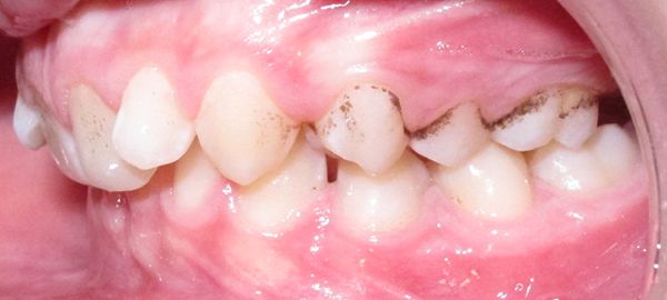 Ortodoncia Adolescentes - Ejemplo 7 - Antes