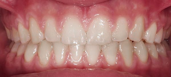 Ortodoncia Adolescentes - Ejemplo 7 - Después