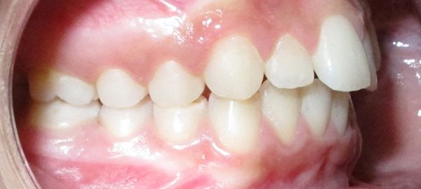 Ortodoncia Adolescentes - Ejemplo 8 - Antes