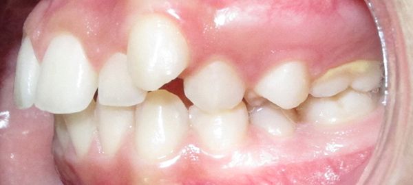Ortodoncia Adolescentes - Ejemplo 8 - Antes