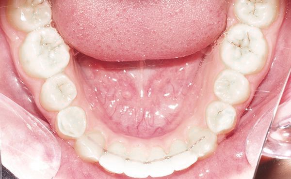 Ortodoncia Adolescentes - Ejemplo 8 - Después