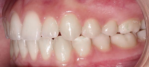 Ortodoncia Adolescentes - Ejemplo 8 - Después