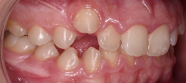 Ortodoncia Adolescentes - Ejemplo 9 - Antes