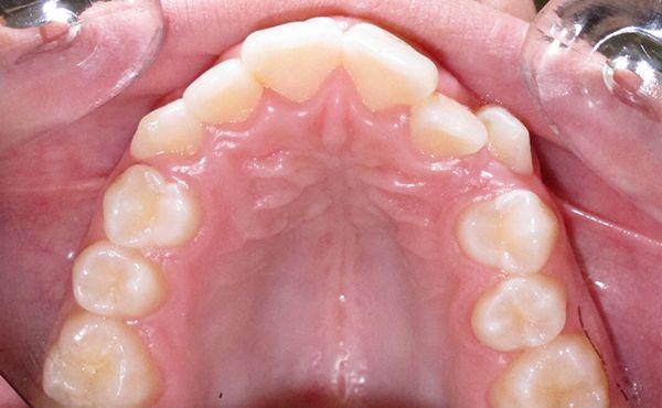 Ortodoncia Adolescentes - Ejemplo 10 - Antes