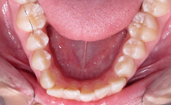 Ortodoncia Adolescentes - Ejemplo 10 - Antes