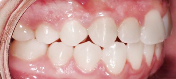 Ortodoncia Adolescentes - Ejemplo 10 - Después