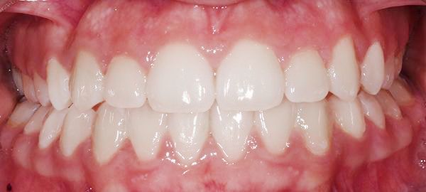 Ortodoncia Adolescentes - Ejemplo 10 - Después