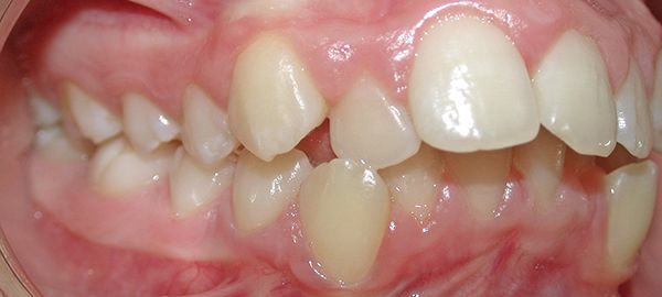 Ortodoncia Adolescentes - Ejemplo 11 - Antes