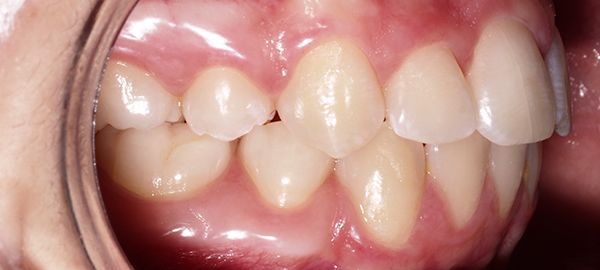 Ortodoncia Adolescentes - Ejemplo 11 - Después