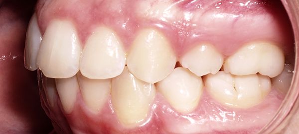 Ortodoncia Adolescentes - Ejemplo 11 - Después