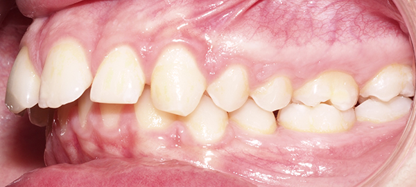 Ortodoncia Adolescentes - Ejemplo 12 - Antes