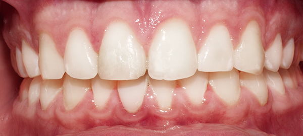 Ortodoncia Adolescentes - Ejemplo 12 - Después