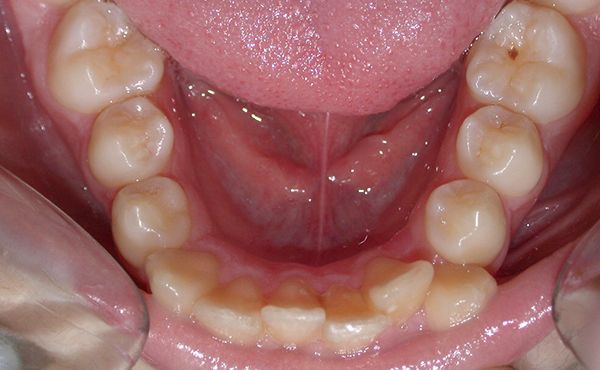 Ortodoncia Adolescentes - Ejemplo 13 - Antes