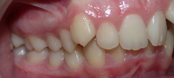 Ortodoncia Adolescentes - Ejemplo 13 - Antes