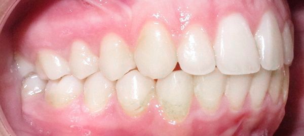 Ortodoncia Adolescentes - Ejemplo 13 - Después