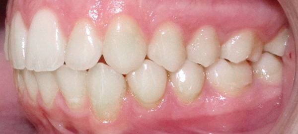 Ortodoncia Adolescentes - Ejemplo 13 - Después