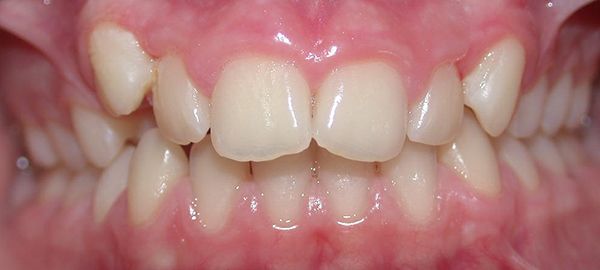 Ortodoncia Adolescentes - Ejemplo 14 - Antes