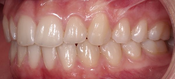 Ortodoncia Adolescentes - Ejemplo 14 - Después