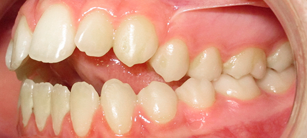Ortodoncia Adolescentes - Ejemplo 15 - Antes
