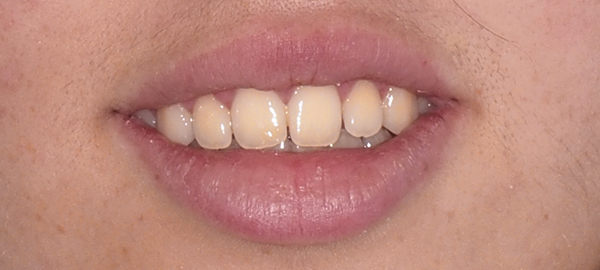 Ortodoncia Adolescentes - Ejemplo 15 - Después