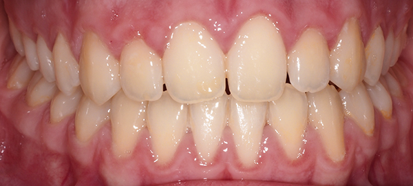 Ortodoncia Adolescentes - Ejemplo 15 - Después