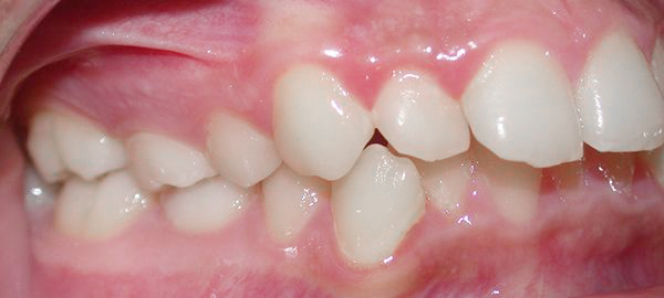 Ortodoncia Adolescentes - Ejemplo 16 - Antes