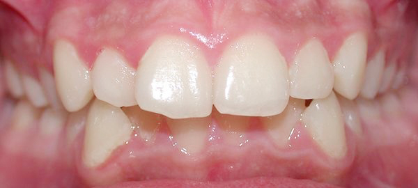 Ortodoncia Adolescentes - Ejemplo 16 - Antes