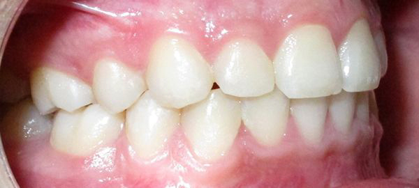 Ortodoncia Adolescentes - Ejemplo 16 - Después