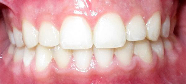 Ortodoncia Adolescentes - Ejemplo 16 - Después