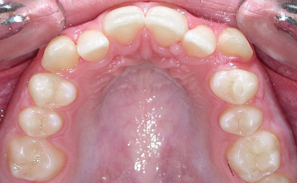 Ortodoncia Adolescentes - Ejemplo 17 - Antes