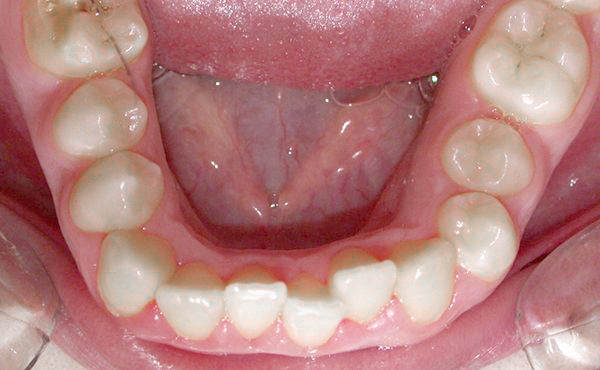 Ortodoncia Adolescentes - Ejemplo 17 - Antes